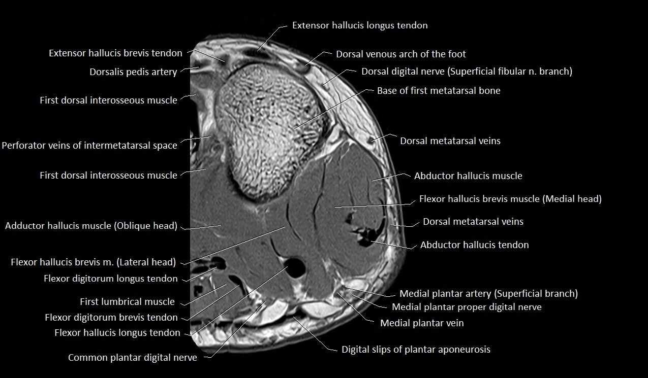 Great toe (hallux) axial microanatomy 3T MRI image 42.webp